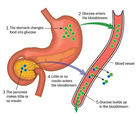 diagram of how how the pancreas processes insulin