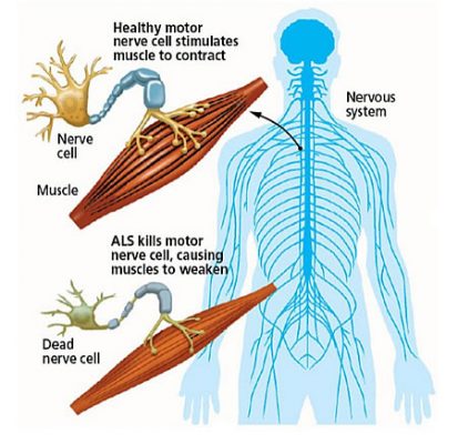 Graphic of nerve cells and how ALS progresses