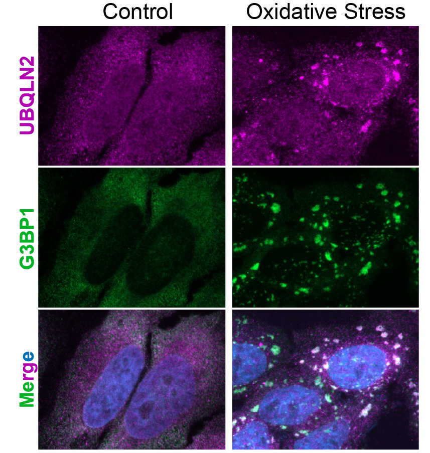 Depiction of temporary condensates under stress conditions. In magenta is one of our target proteins of interest, UBQLN2, and in green is a stress granule (condensate) marker. The bottom row is a merge containing blue for the nucleus